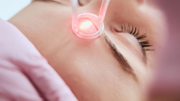 ResurFX Laser Treatment: The Ultimate Solution for Acne Scarring, Stretch Marks, Sun Damage, and Wrinkles