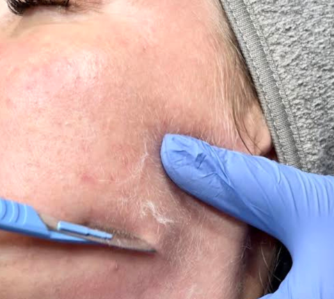 Dermaplaning: Exfoliation and Hair Removal for Smooth Skin