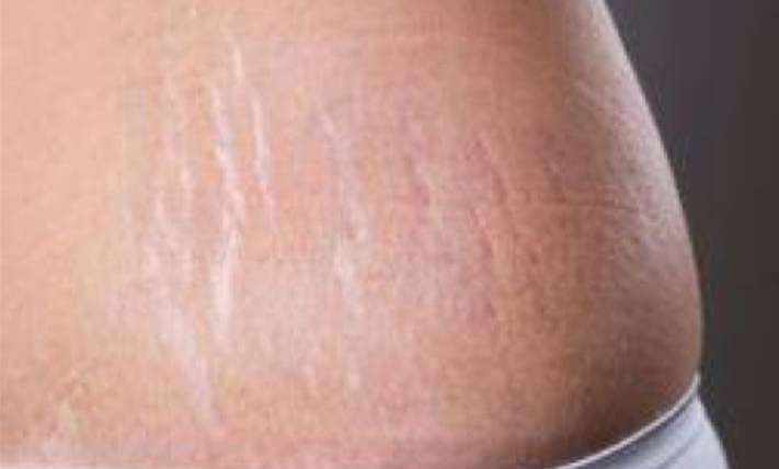 Treating Stretch Marks | Micro-Needling