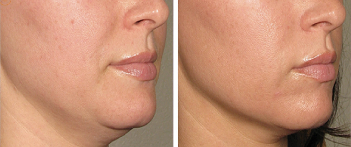 Ultherapy Prime
