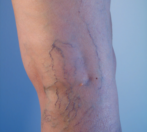 Reveal Your Flawless Beauty: Unveiling the Secrets to Banishing Spider Veins!￼