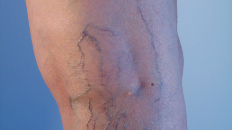 Reveal Your Flawless Beauty: Unveiling the Secrets to Banishing Spider Veins!￼