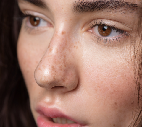 Spot the Difference: Understanding Sun Spots, Freckles, and Age Spots