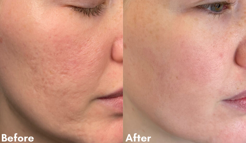 Microneedling