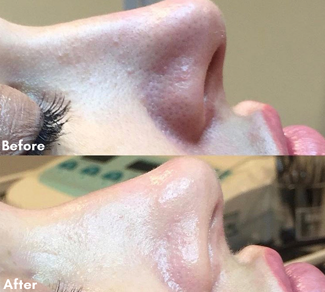 Diamond-microdermabrasion