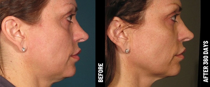 Before After