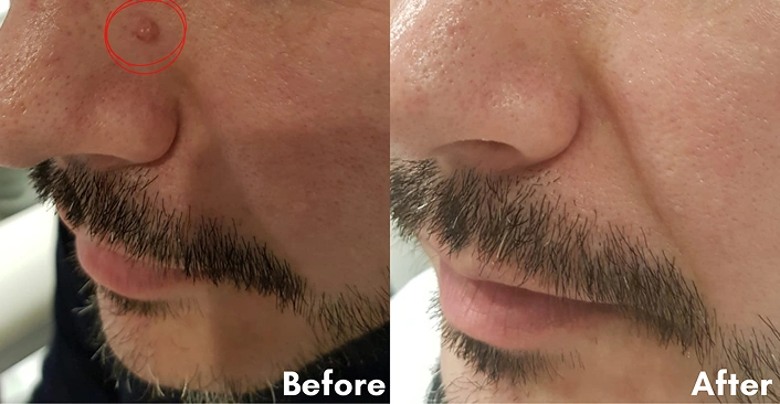 Before After