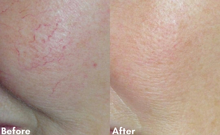 Before After