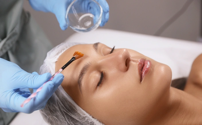 Chemical Peels