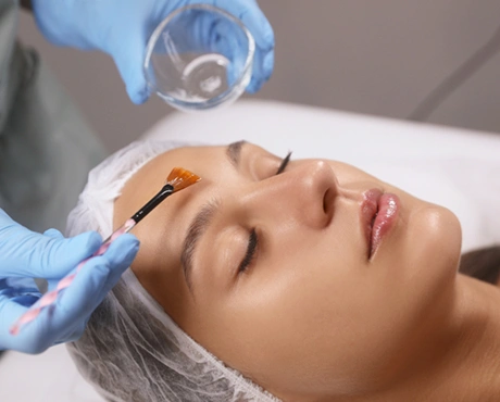Chemical Peels