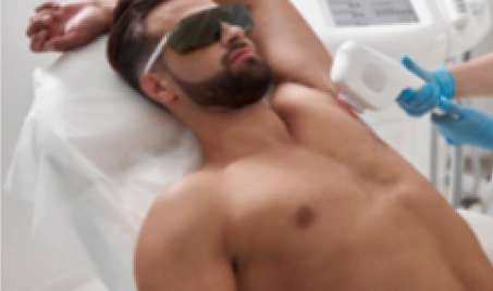 Laser Hair Removal