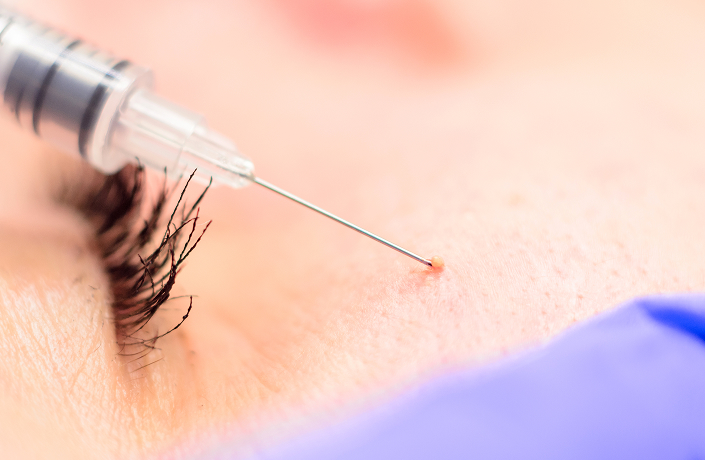 Milia Removal