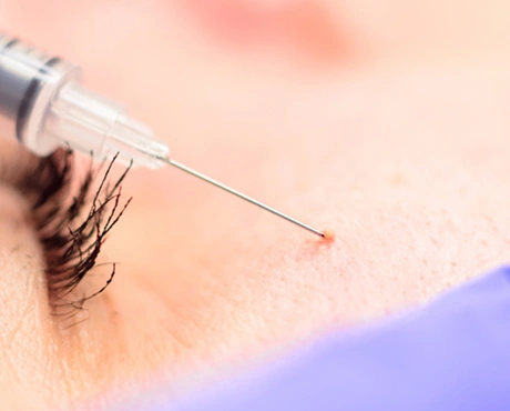 Milia Removal