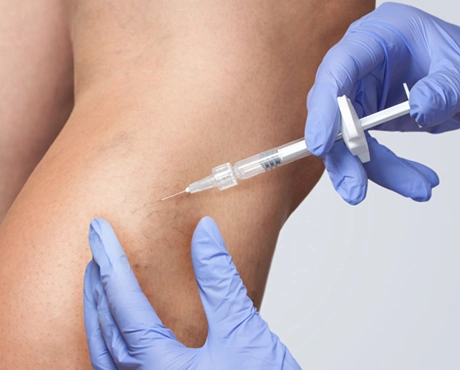 Sclerotherapy