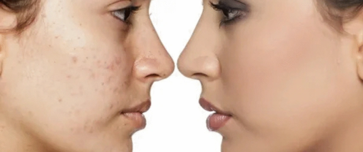 Acne Breakout and Blemishes