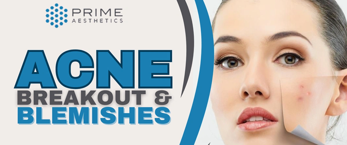 Acne Breakout and Blemishes