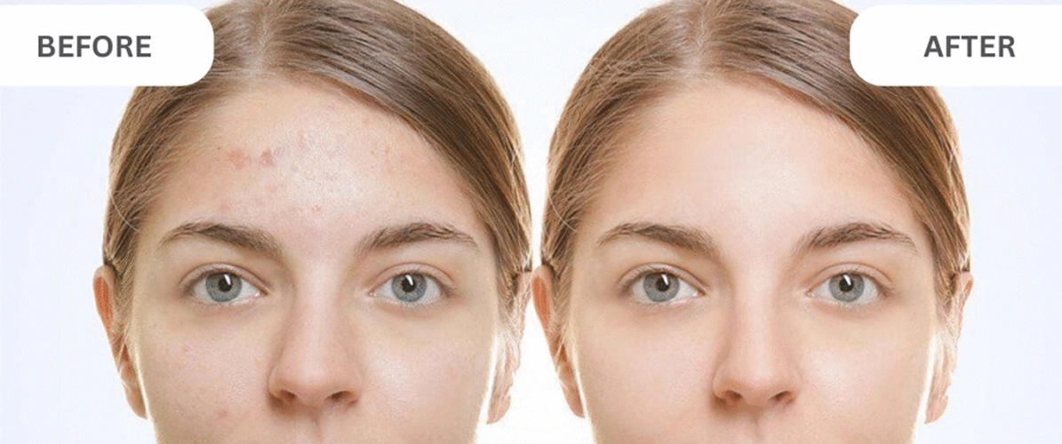 Acne Breakout and Blemishes