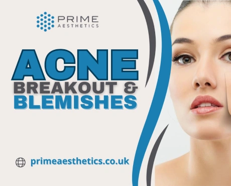 Acne Breakout and Blemishes