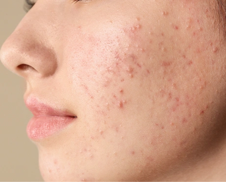 Acne Breakouts Blemishes