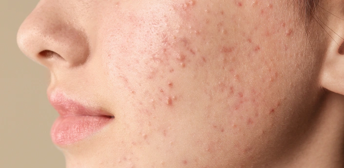 Acne-Breakouts-Blemishes