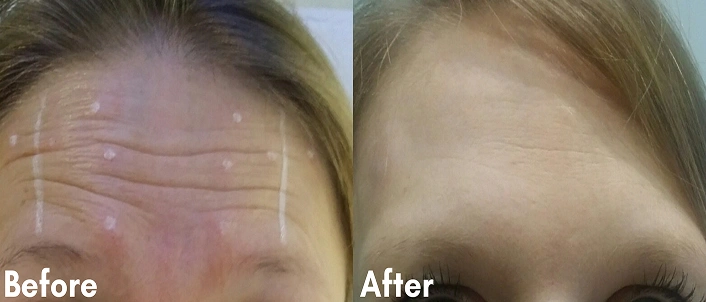 Before After