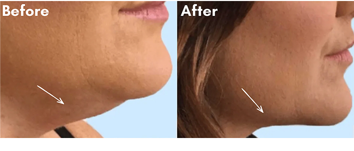 Before After