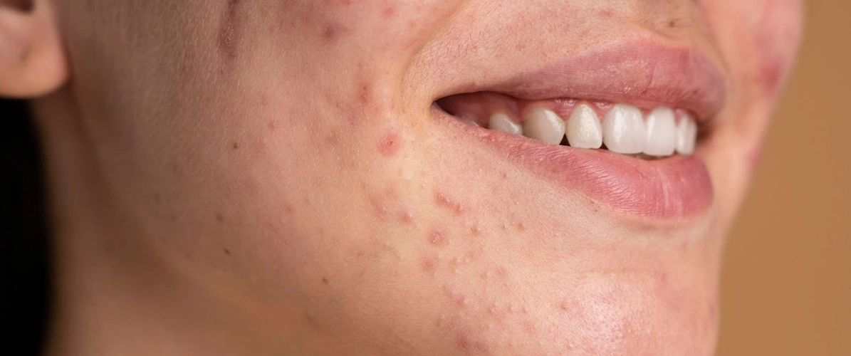 Blemish Clearing Serum