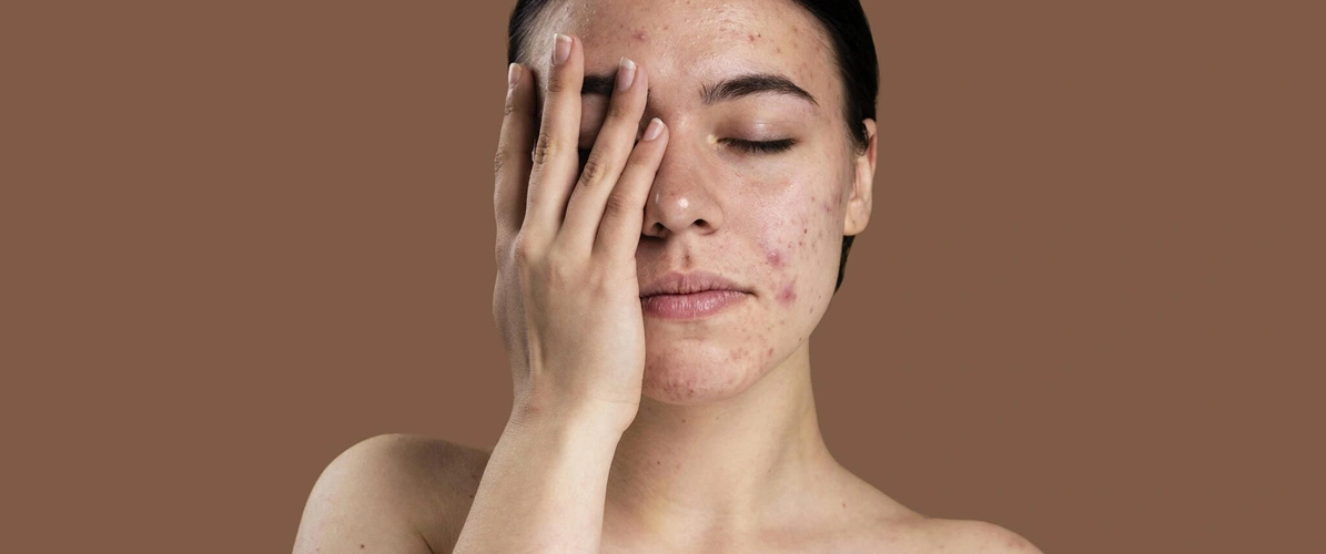 Chemical Peel