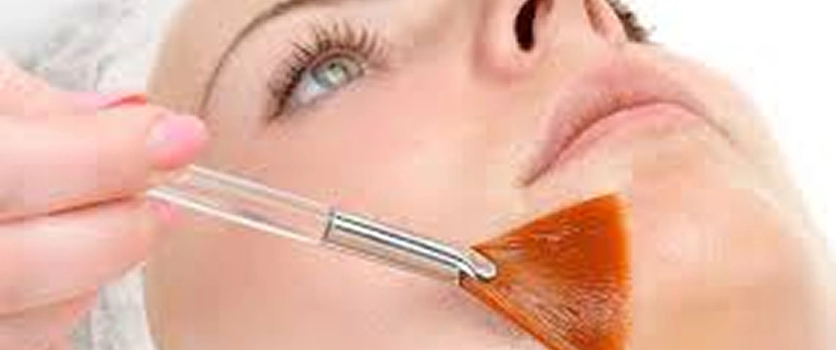 Chemical Peel