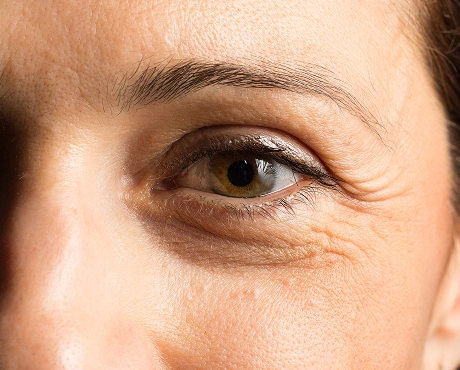 Dark Circles