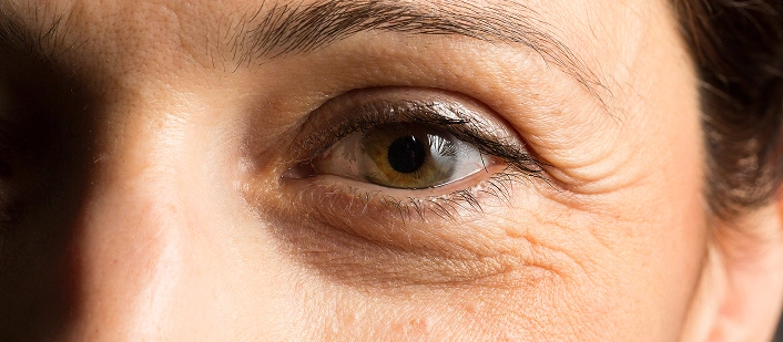 Dark Circles
