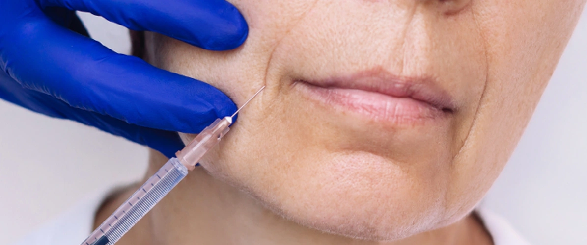 Dermal Fillers to Settle