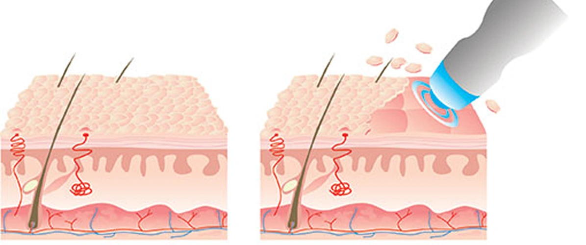 Diamond Microdermabrasion