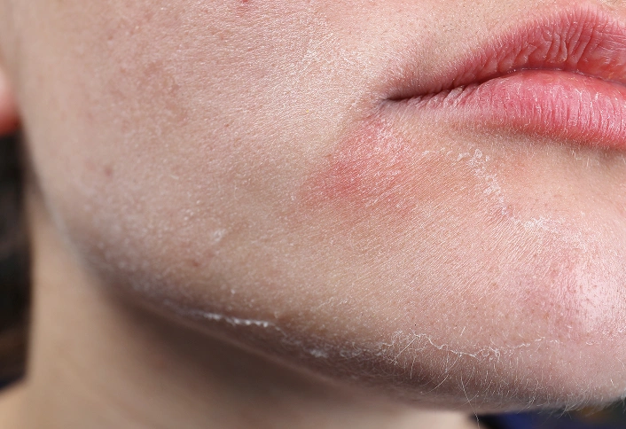 Dry Dull Skin