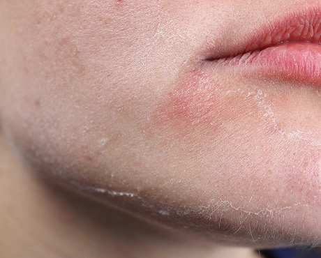 Dry or Dull Skin