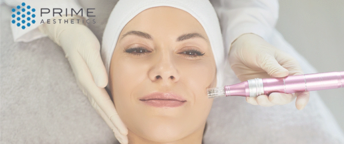 Expert Microneedling Treatment
