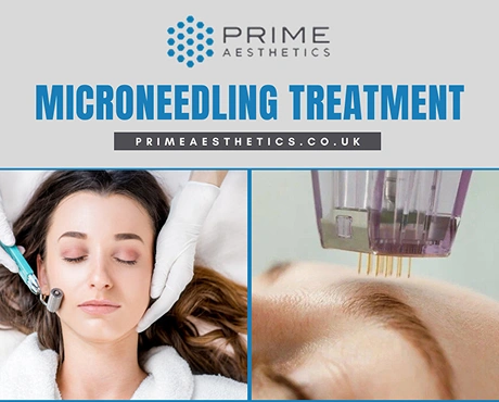 Expert Microneedling Treatment