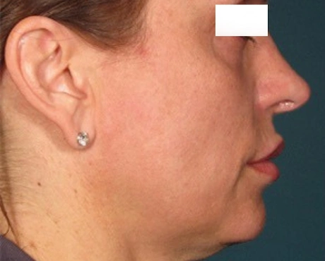 Facial Volume Loss
