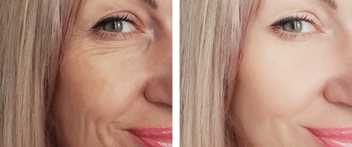 Fighting Fine Lines