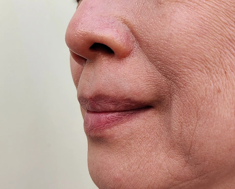 Fine Line Wrinkles