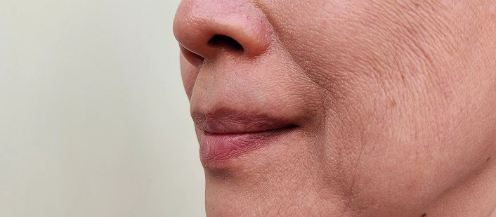 Fine Line Wrinkles
