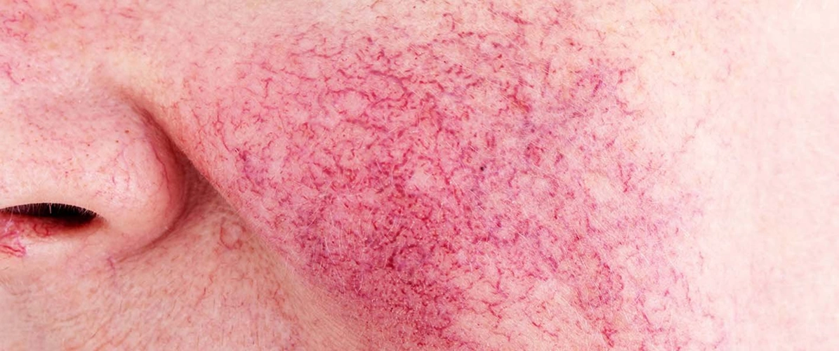 Good for Rosacea