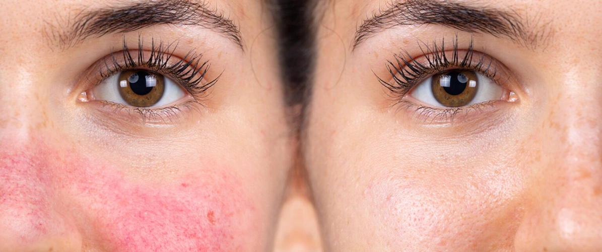 Good for Rosacea