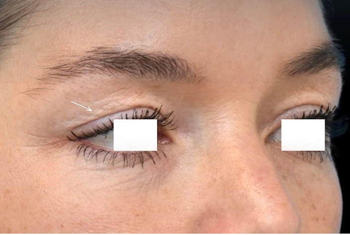 Hooded Upper Eyelids