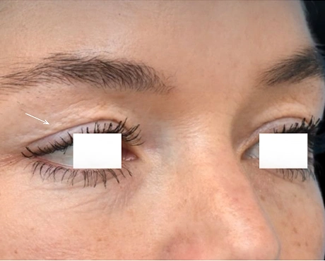 Hooded upper eyelids