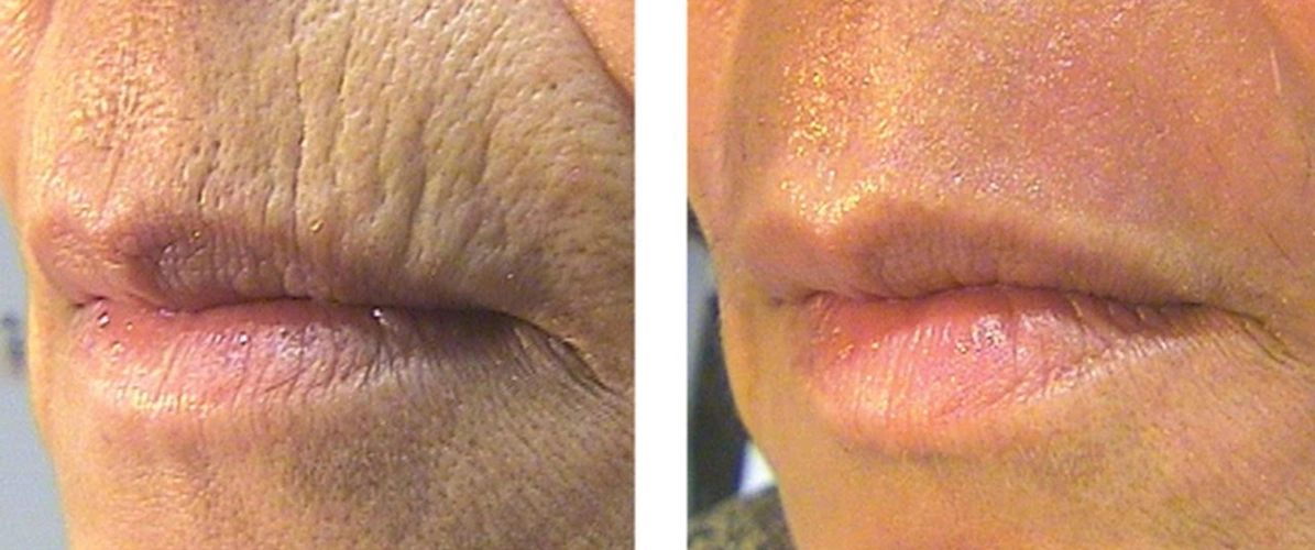 Laser Treatment