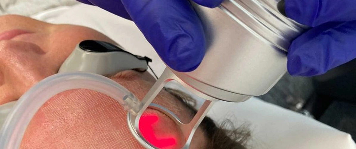 Laser Treatment
