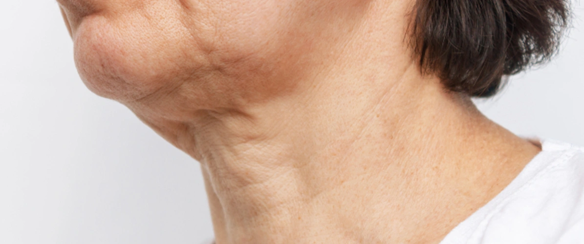 Lose Sagging Skin