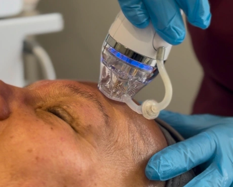 Microneedling RF