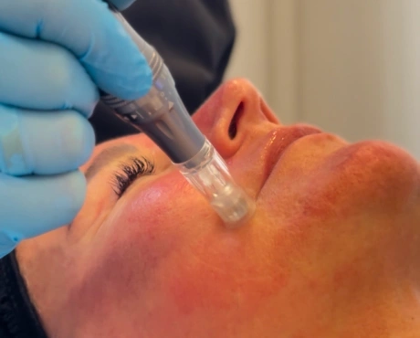 Microneedling